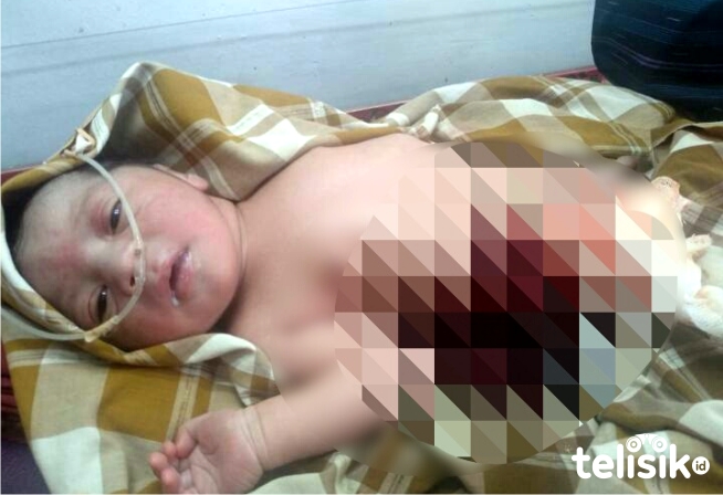 Seorang Bayi di Bombana Lahir Dalam Keadaan Usus Keluar
