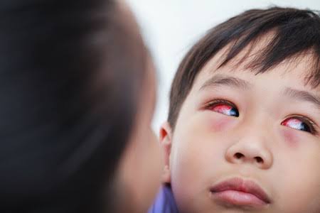 3 Cara Alami Ini Bisa Obati Sakit Mata Tanpa Harus ke Dokter