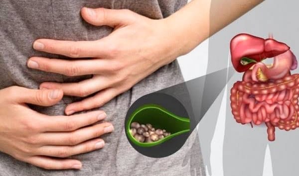 Waspada Gejala Penyakit Batu Empedu Termasuk Komplikasinya