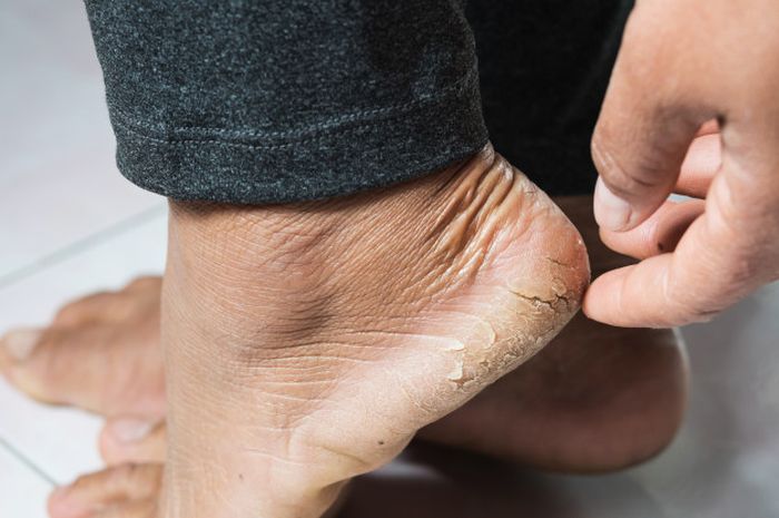 Simak 5 Bahan Alami Atasi Kulit Kaki Pecah-pecah
