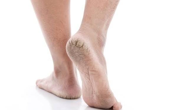 Cara Atasi Tumit dan Kaki Pecah-Pecah