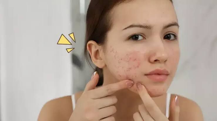 Apakah Memencet Jerawat Berbahaya? Simak Penjelasannya