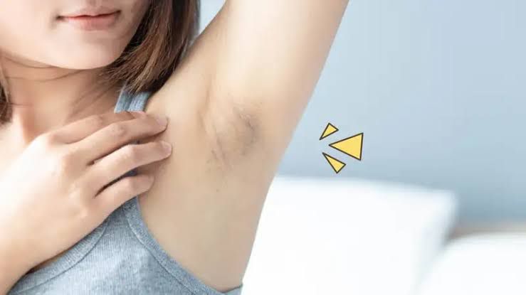 Ini Penyebab dan Cara Mengatasi Ketiak Hitam atau Gelap