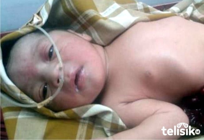 Bayi lahir kondisi usus keluar. Foto: Hir/Telisik