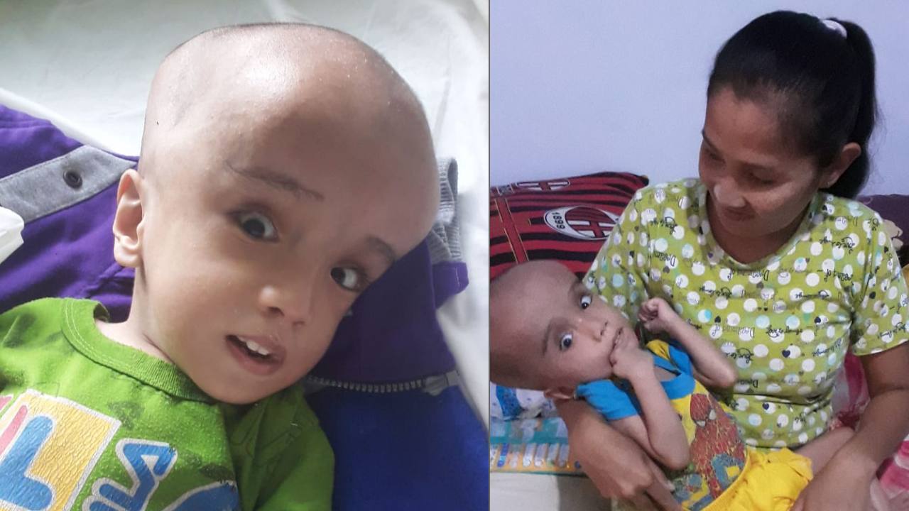Fajril, penderita gizi buruk dan hidrosefalus di Kabupaten Buton. Foto: Ist.