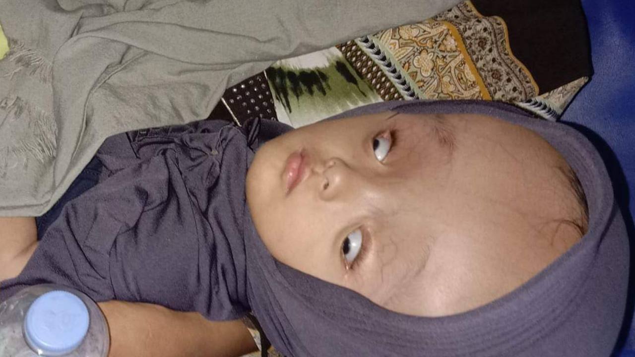 Putri, bayi penderita hidrosefalus dari Muna. Foto: Ist.
