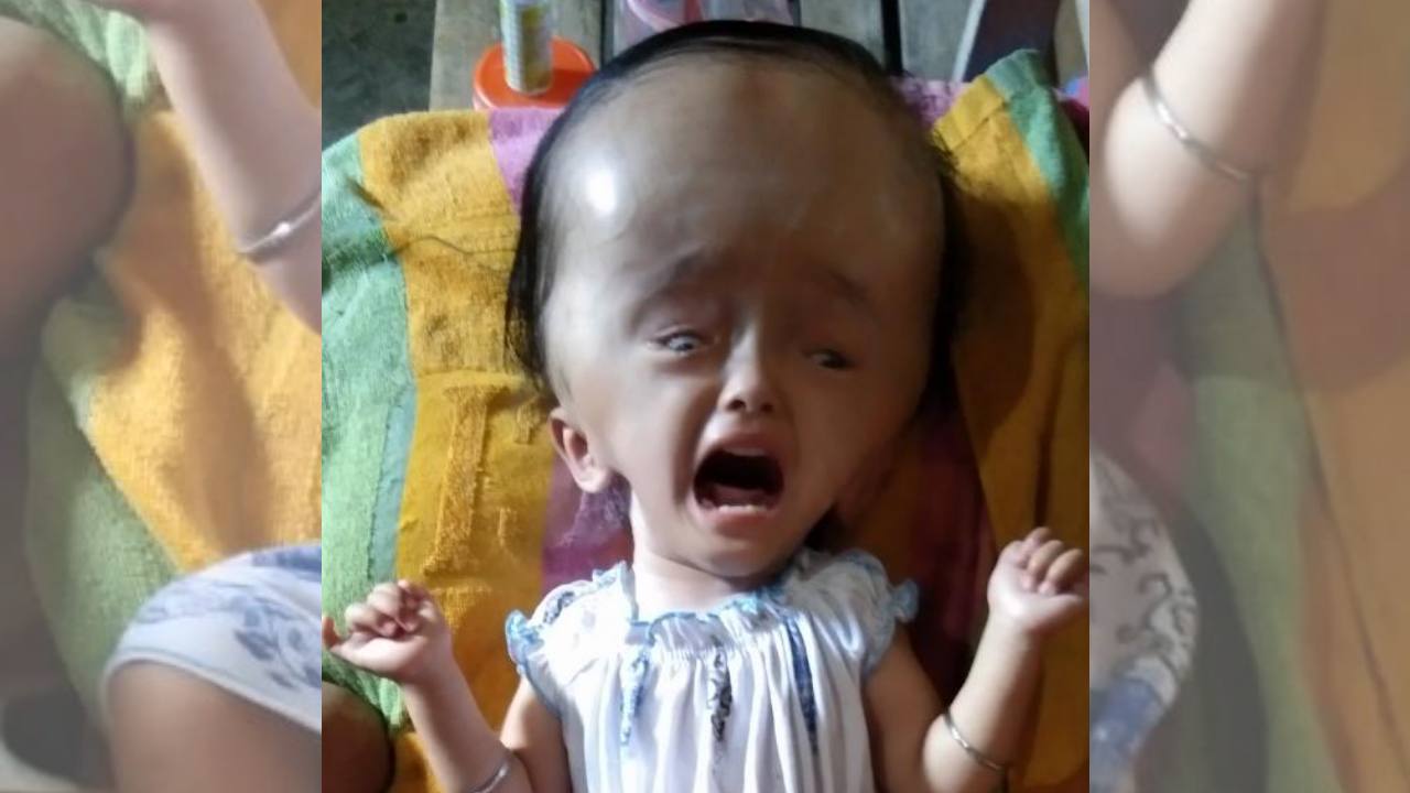 Putri, bayi penderita hidrosefalus asal Muna. Foto: Ist.
