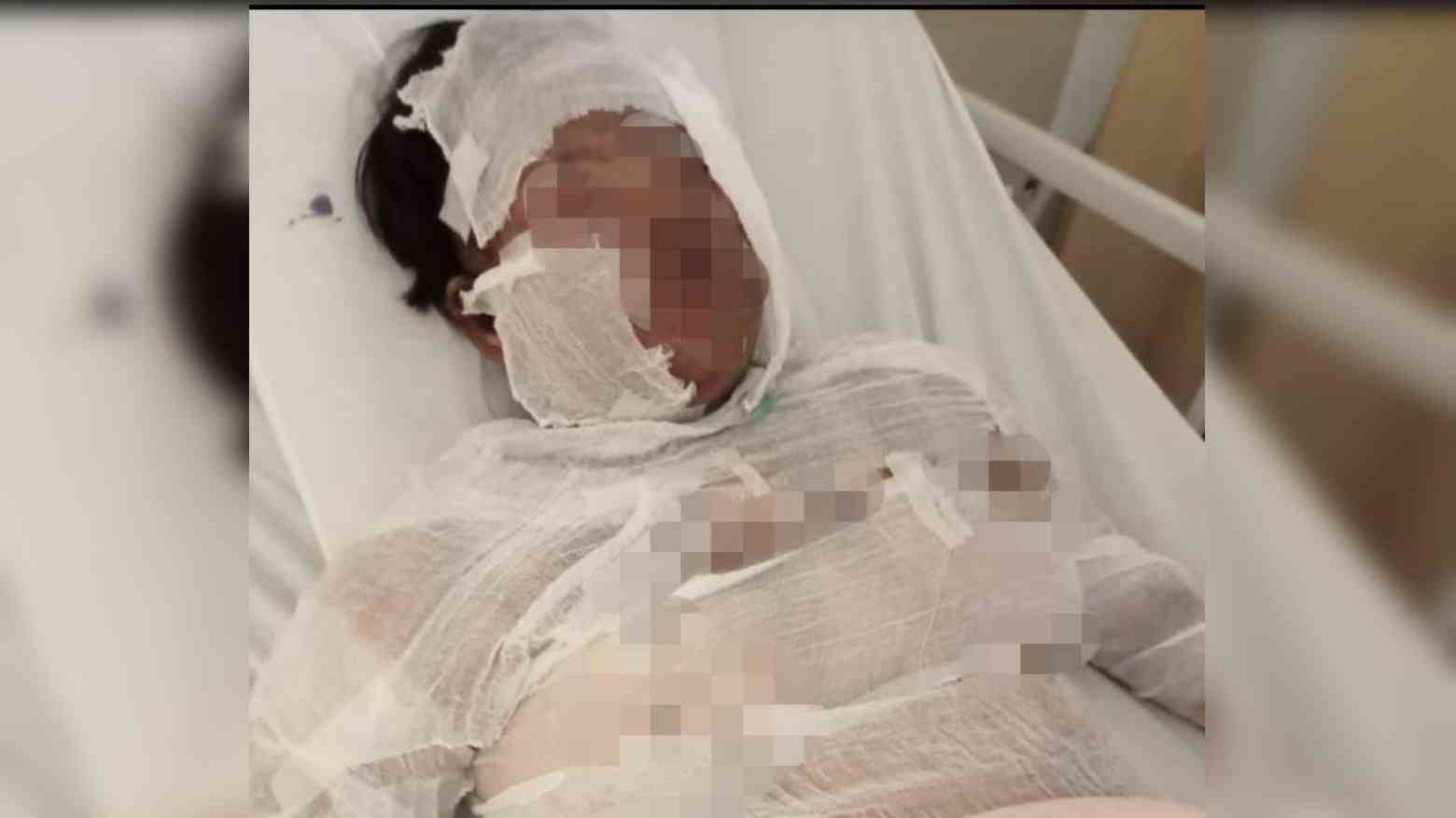 Korban Rani Anggraini saat dirawat di rumah sakit usai dibakar oleh suaminya. Foto: Ones Lawolo/Telisik