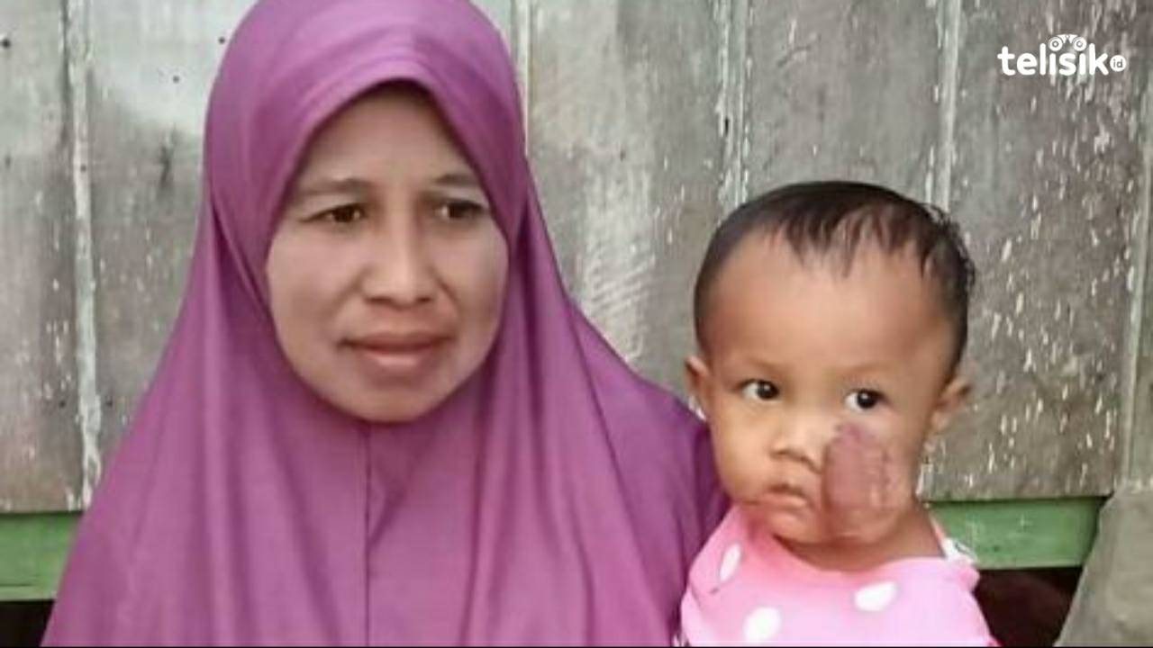 Nurfadila, balita asal buteng derita tumor kulit. Foto: Mutarfin/Telisik