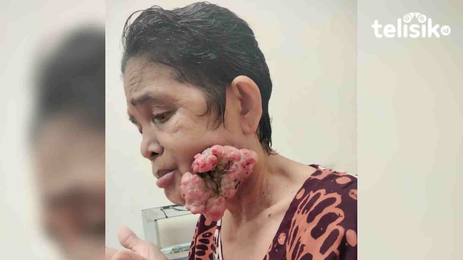 Ibu Jaina, penderita kanker kulit yang hanya bisa pasrah karena tak punya biaya untuk operasi. Foto: Hir/Telisik