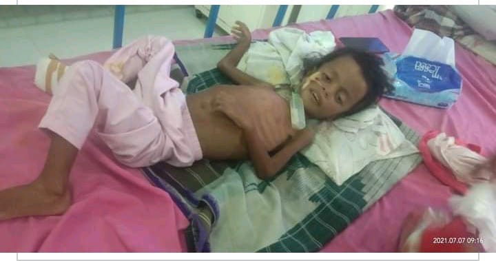 Nur Hafizah, balita asal Buton penderita gizi buruk. Foto: Ist.