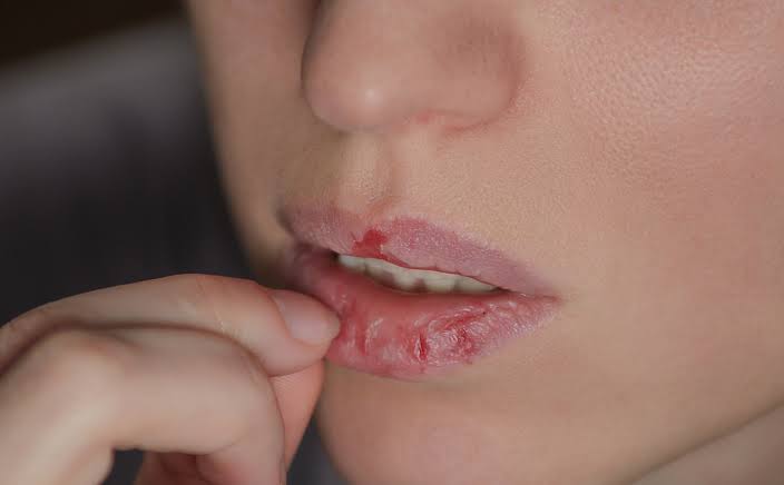 Bibir kering mengganggu penampilan. Foto: Repro honestdocs.id