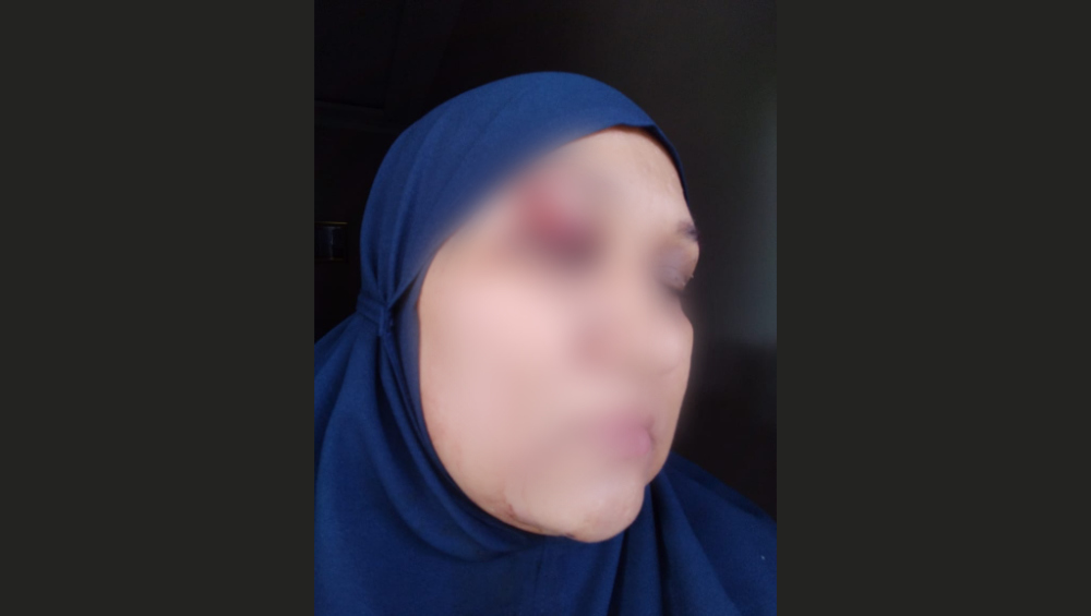 Korban berinisial M dianiaya oknum polisi Aiptu M Irfan yang tidak lain adalah suaminya sendiri. Akibatnya pelipis mata M berdarah. Foto: Ist