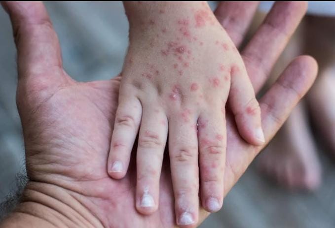 Cacar monyet alias monkeypox adalah penyakit infeksi virus yang disebabkan oleh virus langka dari hewan (virus zoonosis). Wabah ini terjadi pada 6 Mei 2022 di Britania Raya. Foto: Repro hellosehat.com