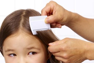 Kutu rambut seringkali dialami seseorang. Hal ini cukup mengganggu aktivitas hari-hari. Foto: Repro pop.grid.id