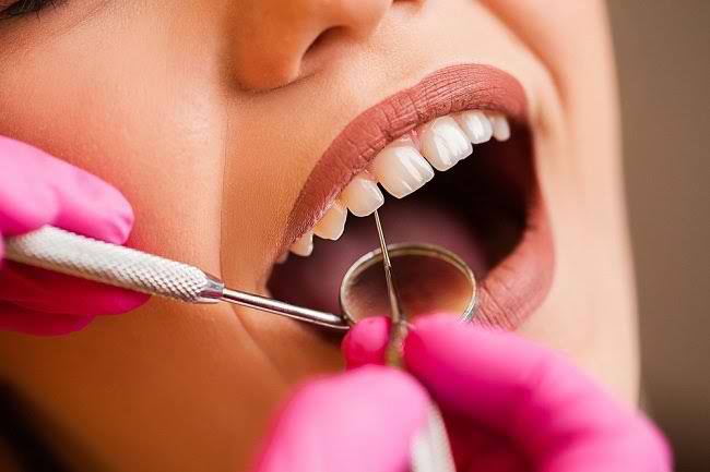 Banyak cara yang bisa dilakukan untuk menghilangkan karang gigi, diantaranya dengan bahan alami. Foto: Repro alodokter.com