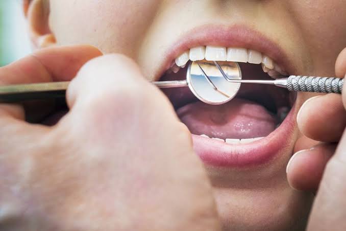 Gigi mengalami keropos karena adanya gangguan yang disebabkan oleh terkikisnya email (enamel) gigi. Foto: Repro shutterstock