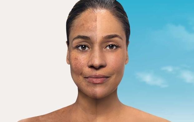 Terlalu lama beraktivitas di bawah sinar matahari bisa membuat kulit terbakar atau sunburn. Namun, tak perlu khawatir karena kondisi tersebut dapat diatasi dengan cara alami. Foto: Blogs.insanmedika.co.id