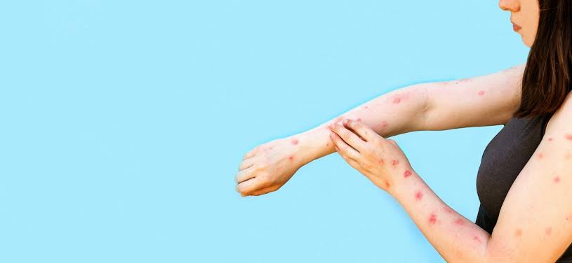 Sifilis atau raja singa termasuk penyakit yang sangat menular, disebarkan melalui aktivitas seksual. Sifilis disebabkan oleh bakteri treponema pallidum. Bakteri ini masuk ke dalam tubuh melalui luka kecil atau lecet pada kulit atau selaput lendir. Foto: R