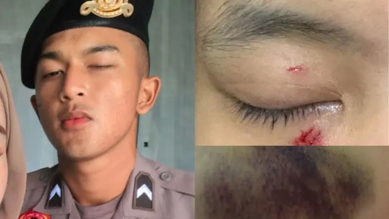 Viral Polisi Aniaya Pacar, korban mengalami luka parah dan trauma. Foto: Repro liputan6.com