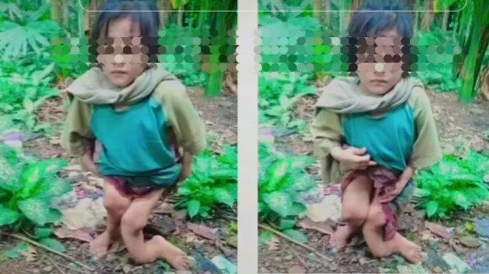 Bocah 10 tahun disiksa kakek, paman dan tantenya setelah ortu bercerai, kaki bengkok. Foto: Repro tribunnews