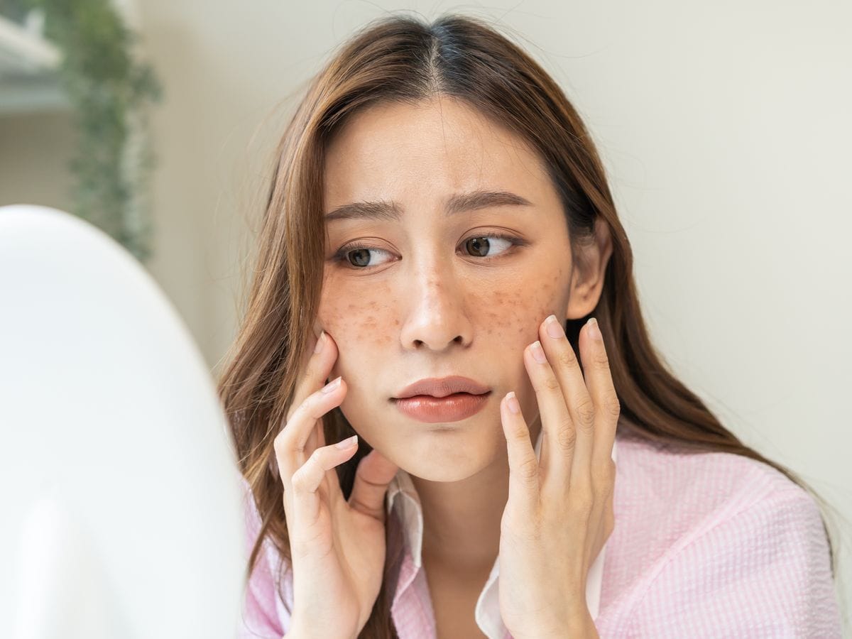 Ilustrasi seorang perempuan dengan flek hitam pada wajah. Foto: Kompas.com